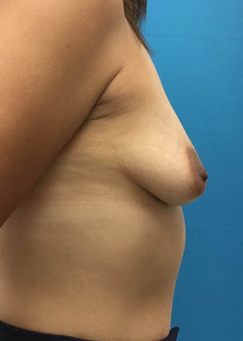 Breast Augmentation Before & After Gallery - Patient 46614422 - Image 3