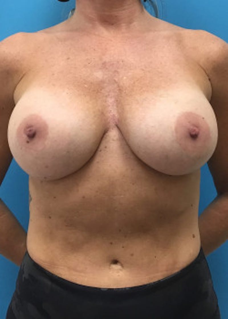Breast Augmentation Before & After Gallery - Patient 46614455 - Image 1