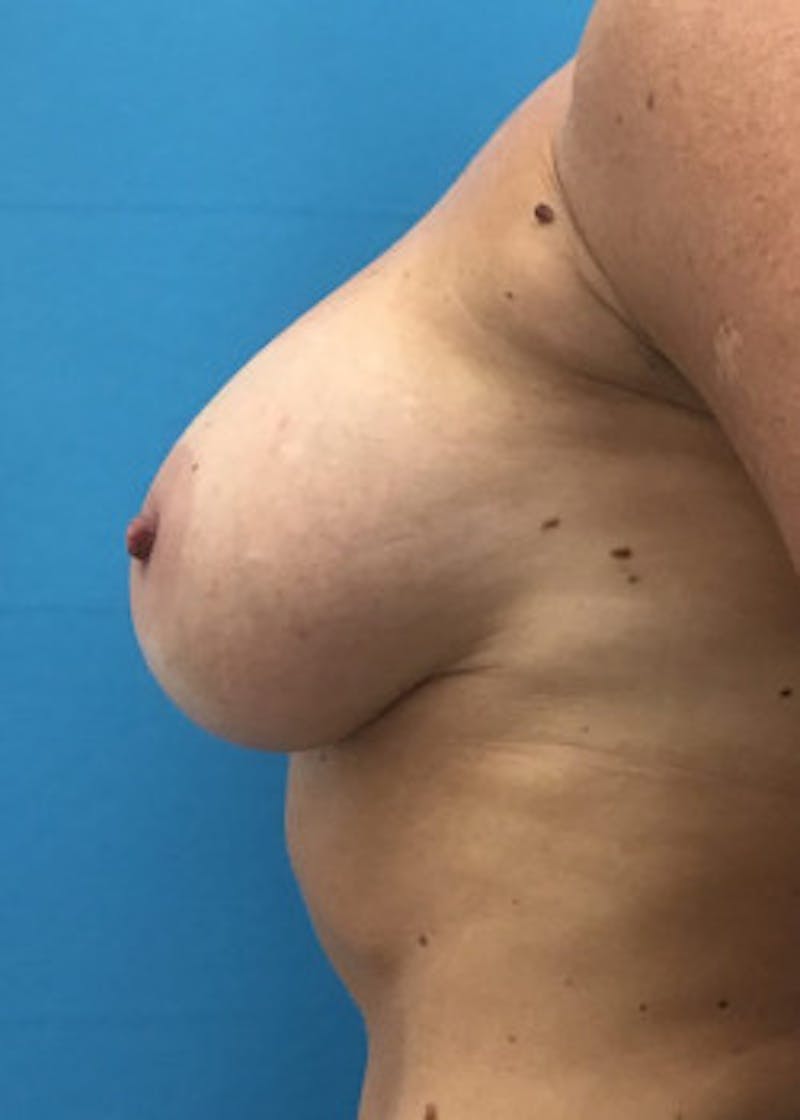 Breast Augmentation Before & After Gallery - Patient 46614455 - Image 3