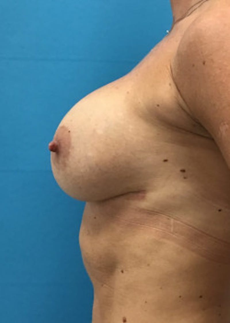 Breast Augmentation Before & After Gallery - Patient 46614455 - Image 4