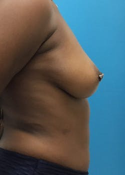 Breast Augmentation Gallery - Patient 46614493 - Image 3
