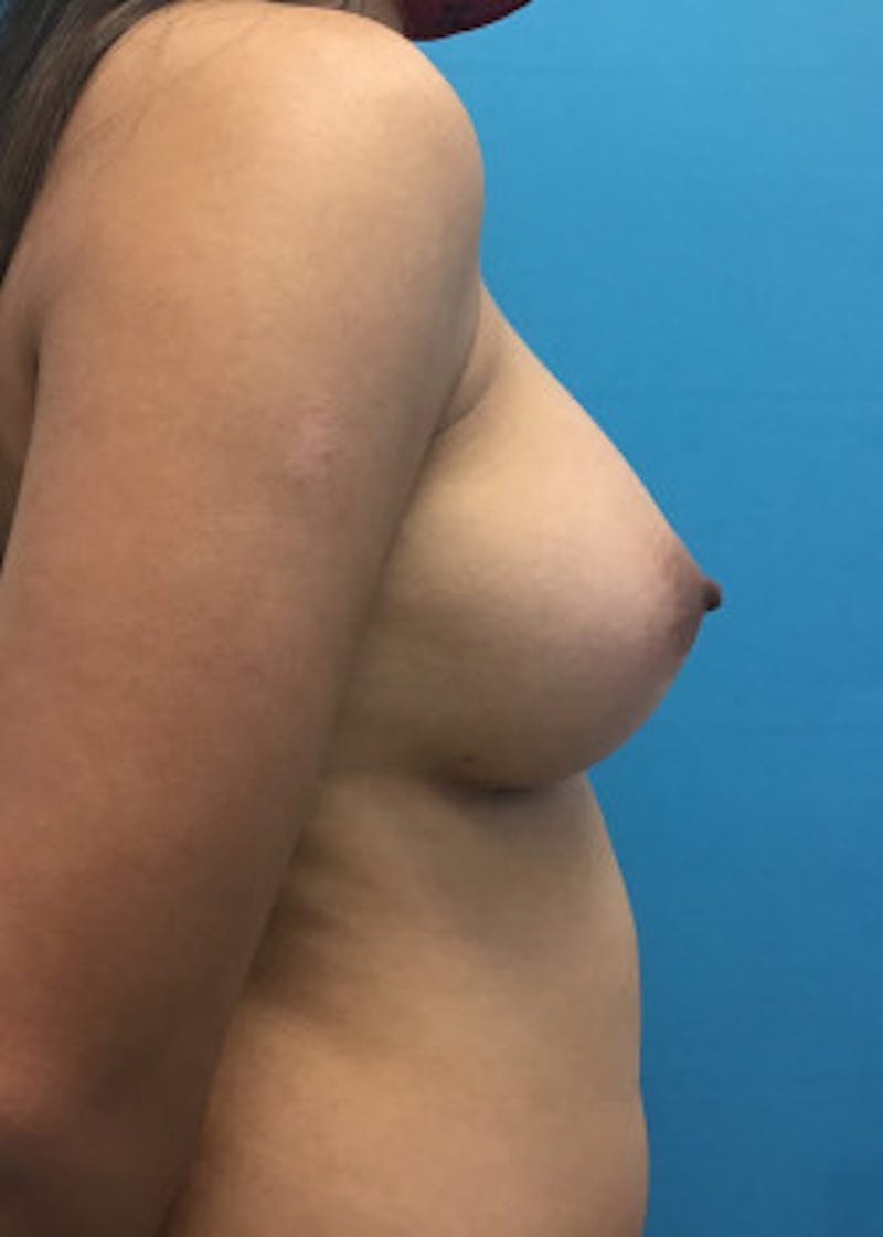 Breast Augmentation Before & After Gallery - Patient 46614524 - Image 4