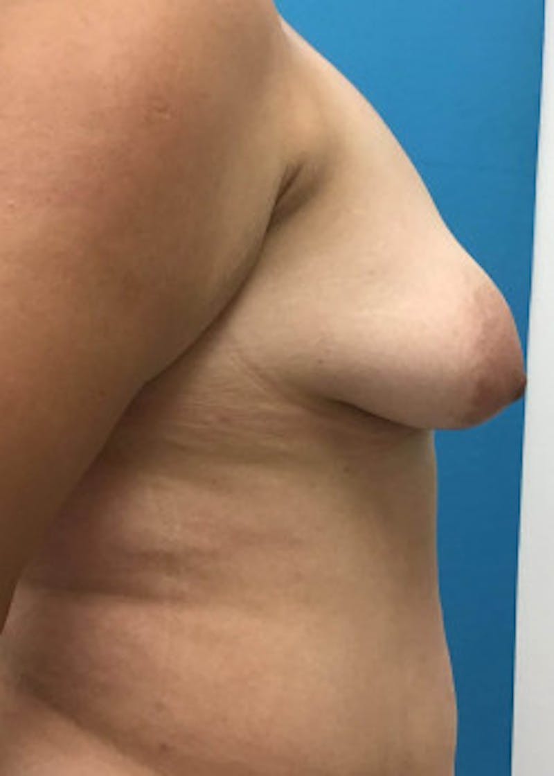 Breast Augmentation Before & After Gallery - Patient 46614561 - Image 3