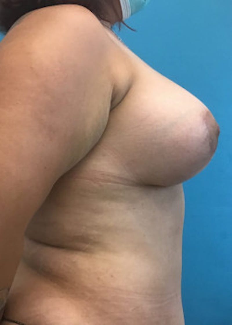 Breast Augmentation Before & After Gallery - Patient 46614561 - Image 4