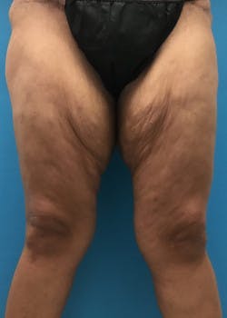 Thigh Lift in Friendswood & League City Before & After Photos