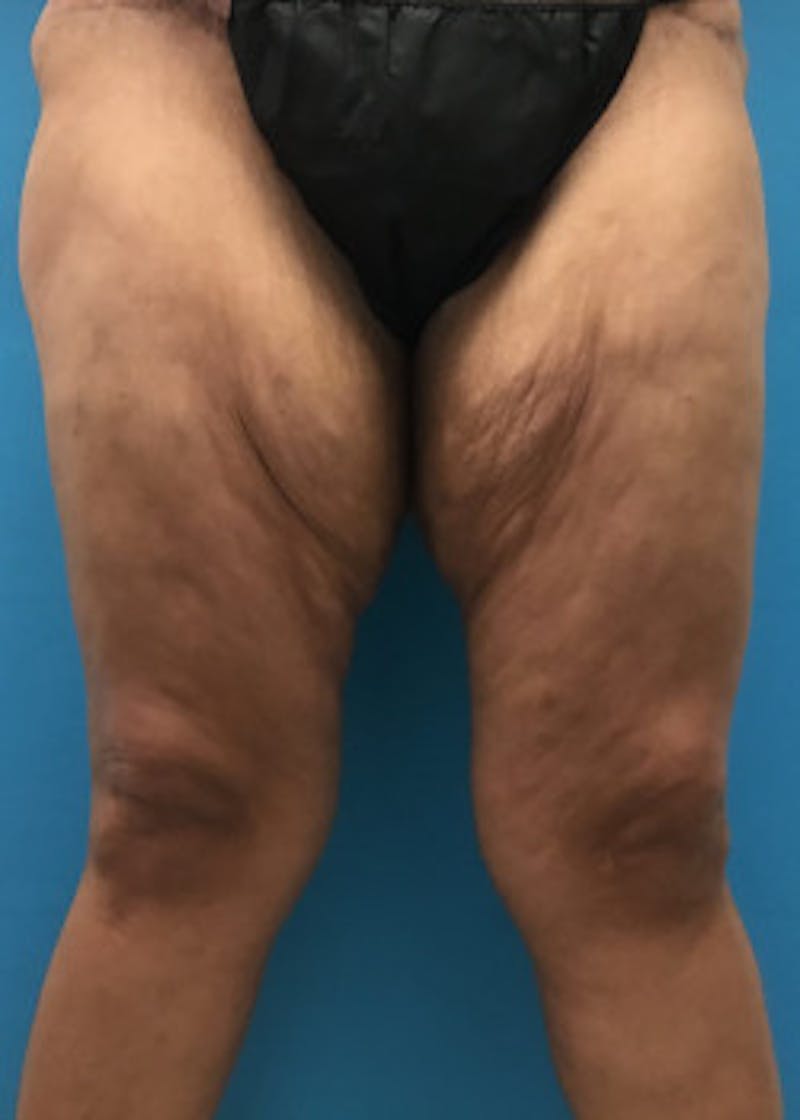 Thigh Lift Before & After Gallery - Patient 46616342 - Image 1
