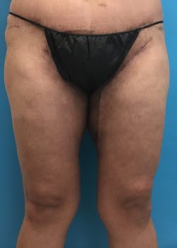 Thigh Lift in Friendswood & League City Before & After Photos