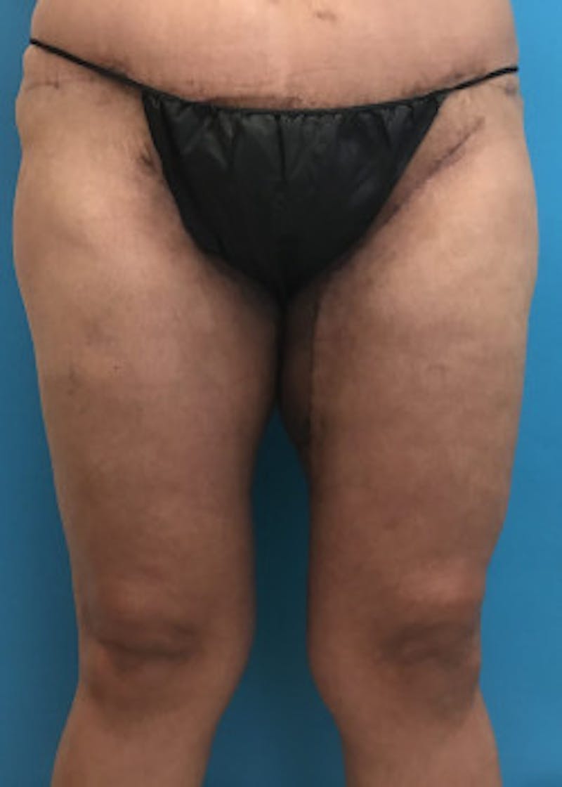 Thigh Lift Before & After Gallery - Patient 46616342 - Image 2