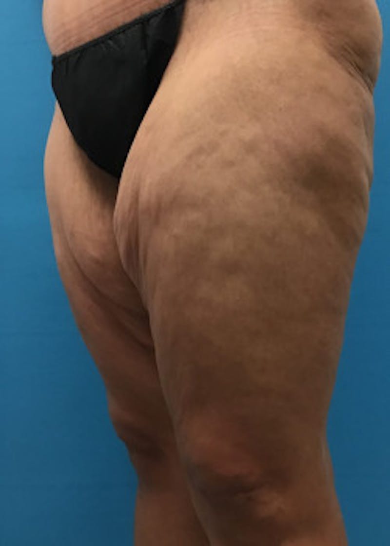 Thigh Lift Before & After Gallery - Patient 46616342 - Image 3