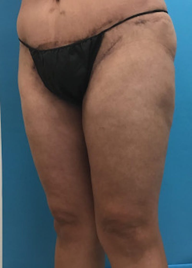 Thigh Lift Before & After Gallery - Patient 46616342 - Image 4