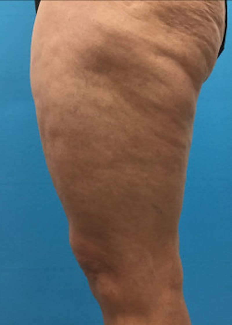 Thigh Lift Before & After Gallery - Patient 46616342 - Image 5