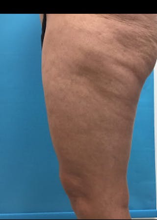 Thigh Lift Before & After Gallery - Patient 46616342 - Image 6