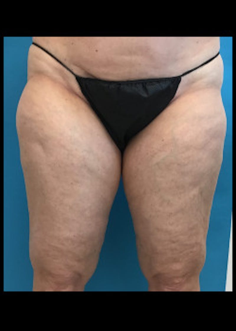 Thigh Lift Before & After Gallery - Patient 46616385 - Image 1