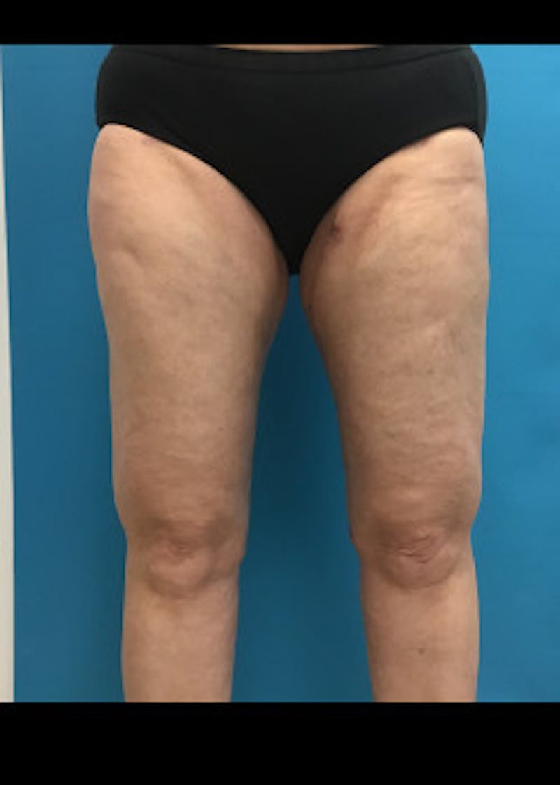 Thigh Lift Before & After Gallery - Patient 46616385 - Image 2