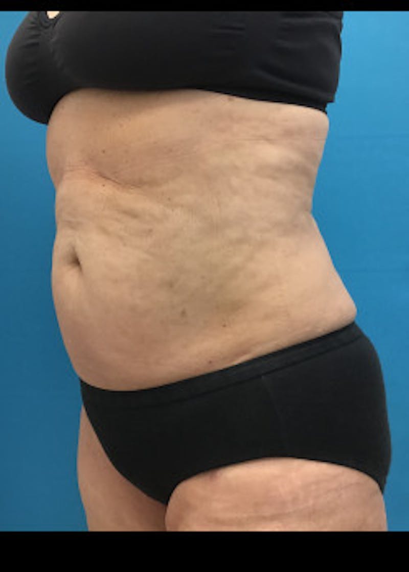 Thigh Lift Before & After Gallery - Patient 46616385 - Image 6