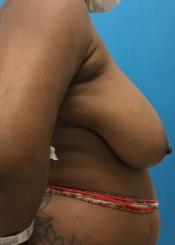 Breast Reduction Gallery - Patient 46617276 - Image 3