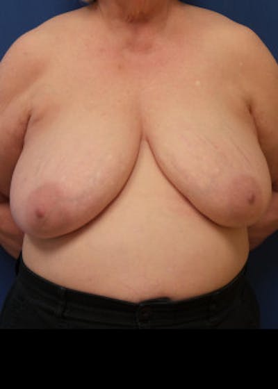 Breast Reduction Before & After Gallery - Patient 46617310 - Image 1