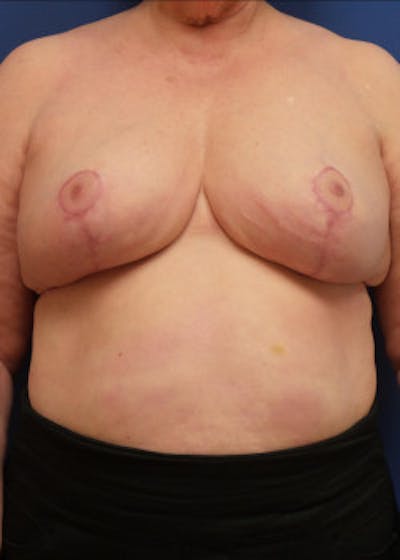 Breast Reduction Before & After Gallery - Patient 46617310 - Image 2