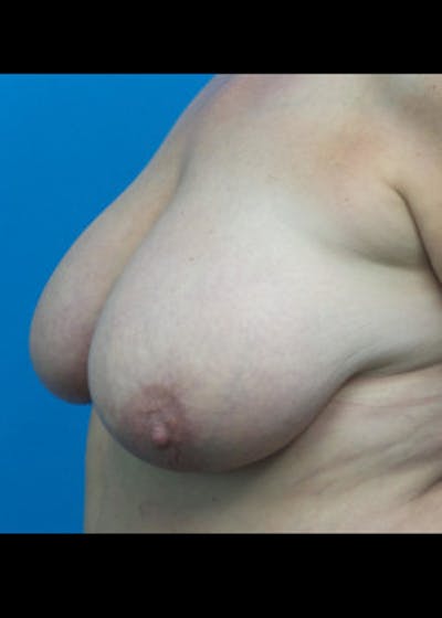 Breast Reduction Before & After Gallery - Patient 46617334 - Image 1