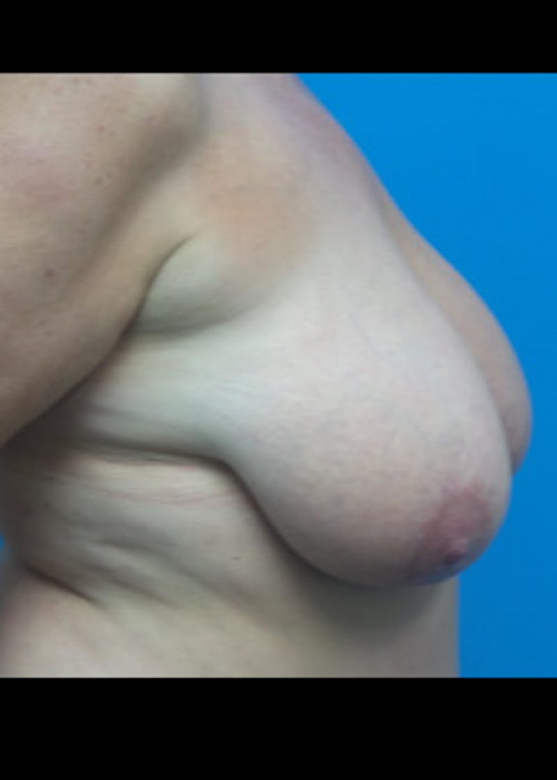 Breast Reduction Before & After Gallery - Patient 46617334 - Image 3
