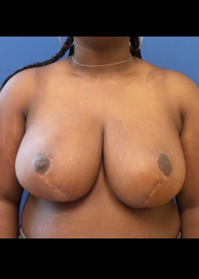 Breast Reduction Before & After Gallery - Patient 46617399 - Image 2