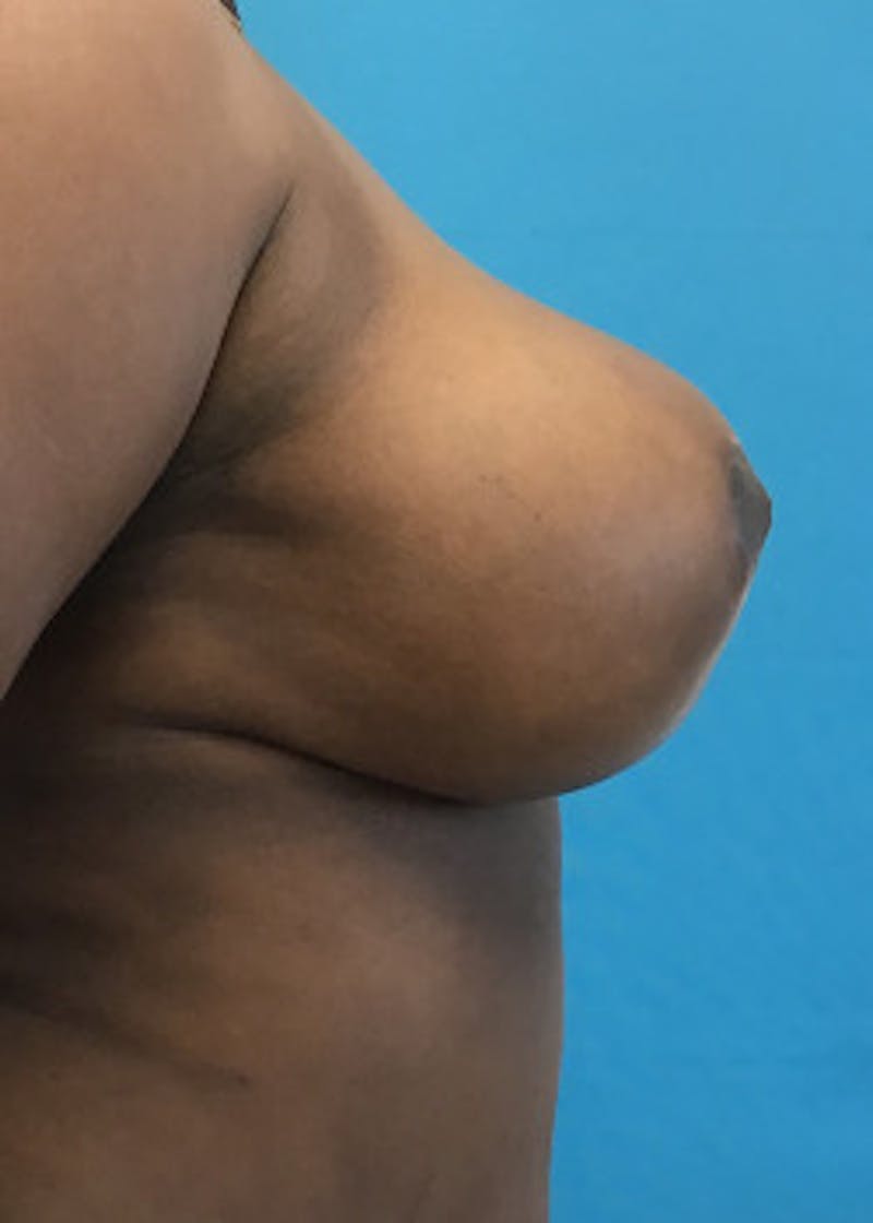 Breast Reduction Before & After Gallery - Patient 46617433 - Image 4