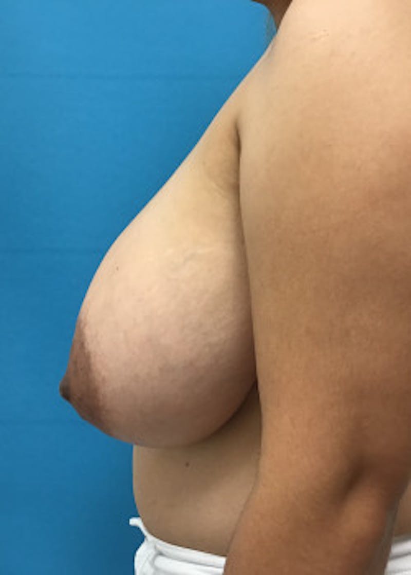 Breast Reduction Before & After Gallery - Patient 46617489 - Image 3