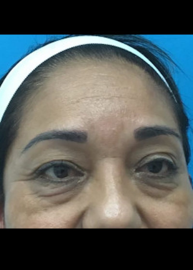 Browlift Before & After Gallery - Patient 46618494 - Image 1