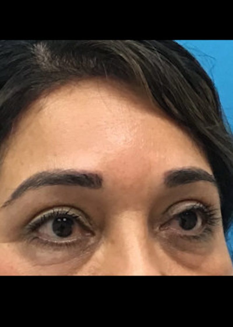 Browlift Before & After Gallery - Patient 46618494 - Image 2