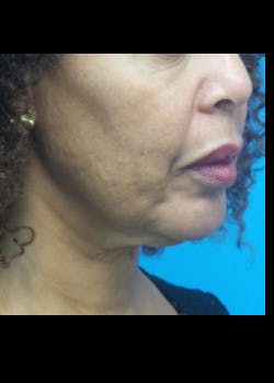 Facelift