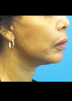 Facelift