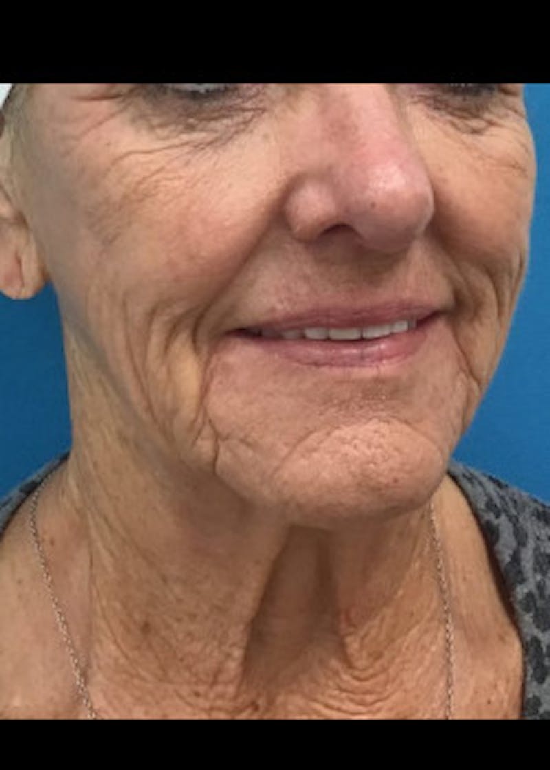 Facelift Before & After Gallery - Patient 46618582 - Image 1