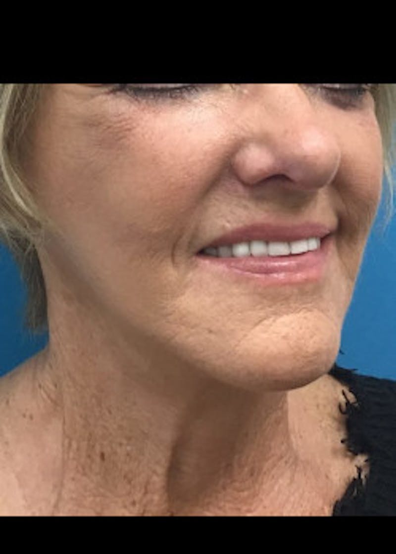 Facelift Before & After Gallery - Patient 46618582 - Image 2