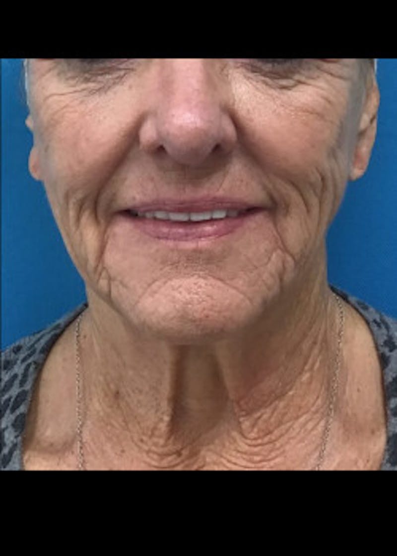 Facelift Before & After Gallery - Patient 46618582 - Image 3