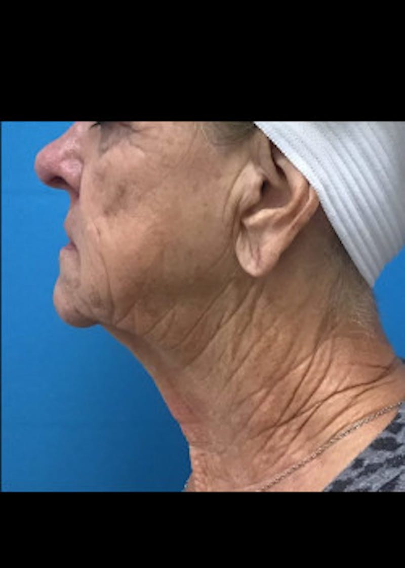 Facelift Before & After Gallery - Patient 46618582 - Image 5