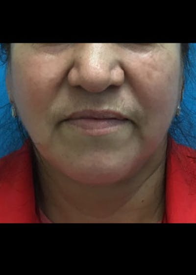 Jaw Contouring Before & After Gallery - Patient 46618664 - Image 2