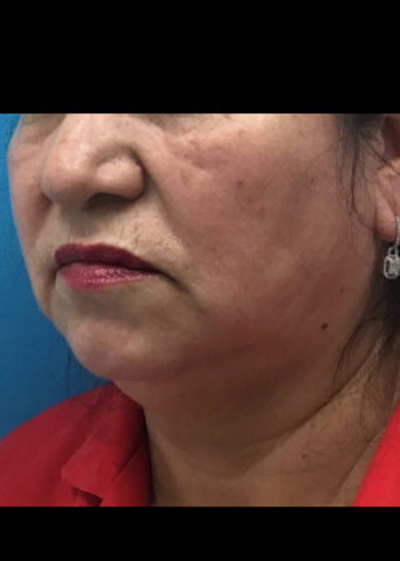 Jaw Contouring Before & After Gallery - Patient 46618664 - Image 3