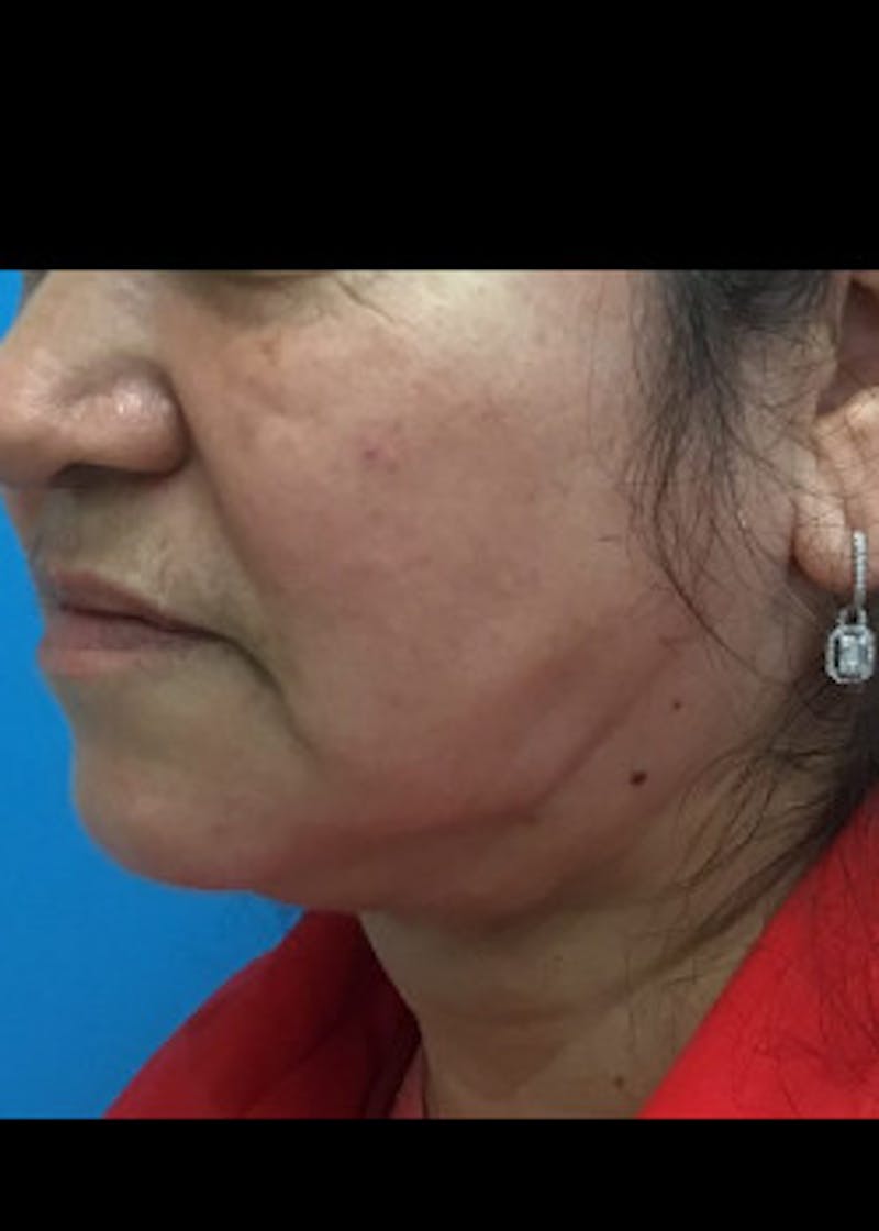 Jaw Contouring Before & After Gallery - Patient 46618664 - Image 4