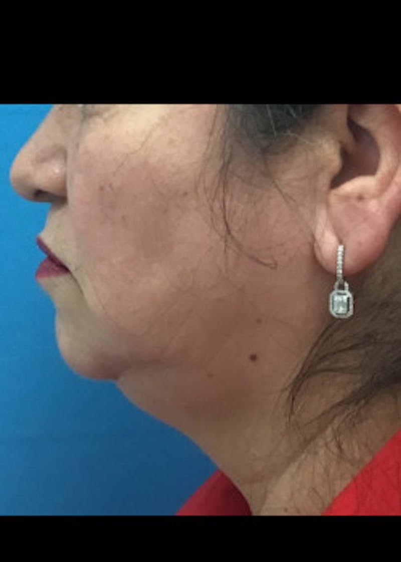 Jaw Contouring Before & After Gallery - Patient 46618664 - Image 5