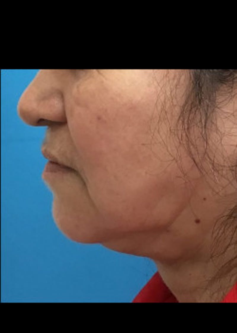 Jaw Contouring Before & After Gallery - Patient 46618664 - Image 6