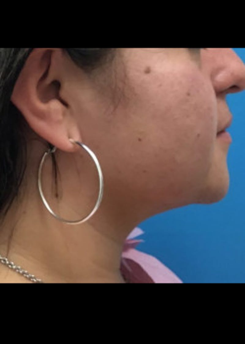 Jaw Contouring Before & After Gallery - Patient 46618737 - Image 2