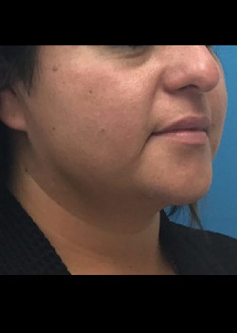 Jaw Contouring Before & After Gallery - Patient 46618737 - Image 3