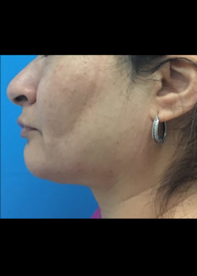 Jaw Contouring Before & After Gallery - Patient 46618756 - Image 2
