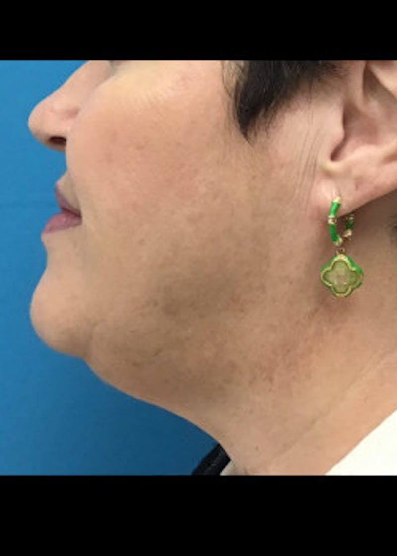 Jaw Contouring Before & After Gallery - Patient 46618801 - Image 1