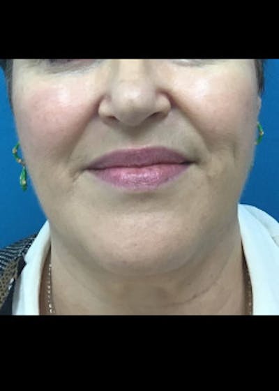 Jaw Contouring Before & After Gallery - Patient 46618801 - Image 1