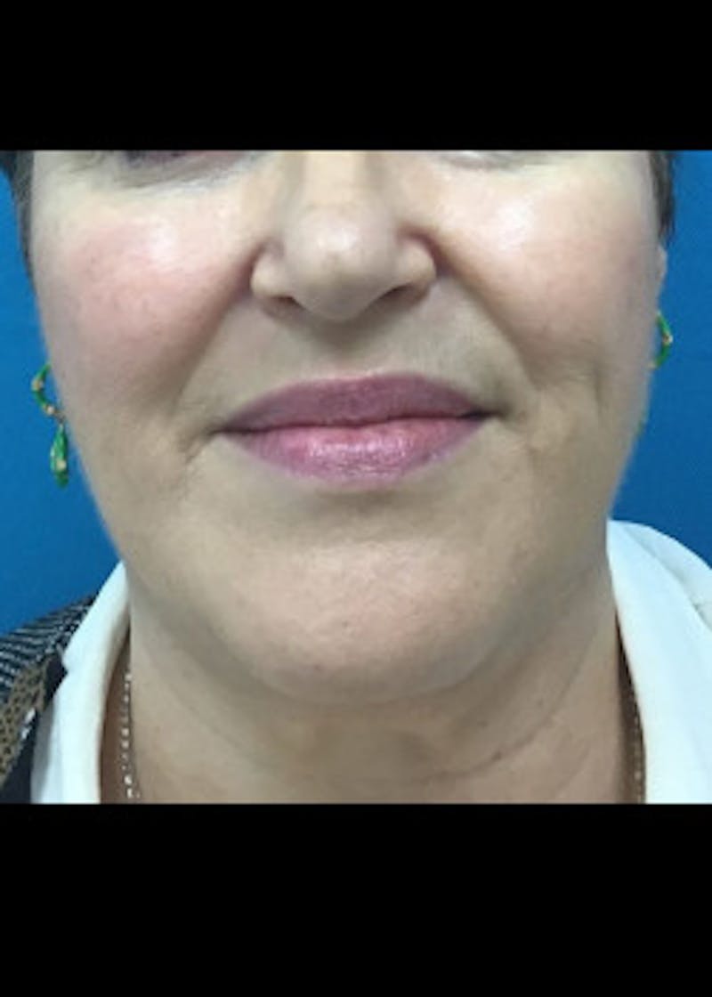 Jaw Contouring Before & After Gallery - Patient 46618801 - Image 3