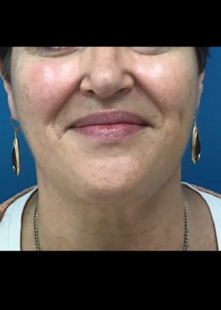Jaw Contouring Before & After Gallery - Patient 46618801 - Image 2