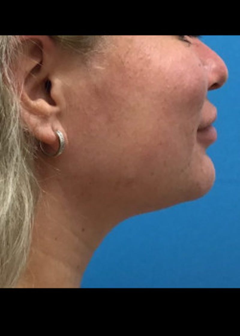 Jaw Contouring Before & After Gallery - Patient 46618842 - Image 2
