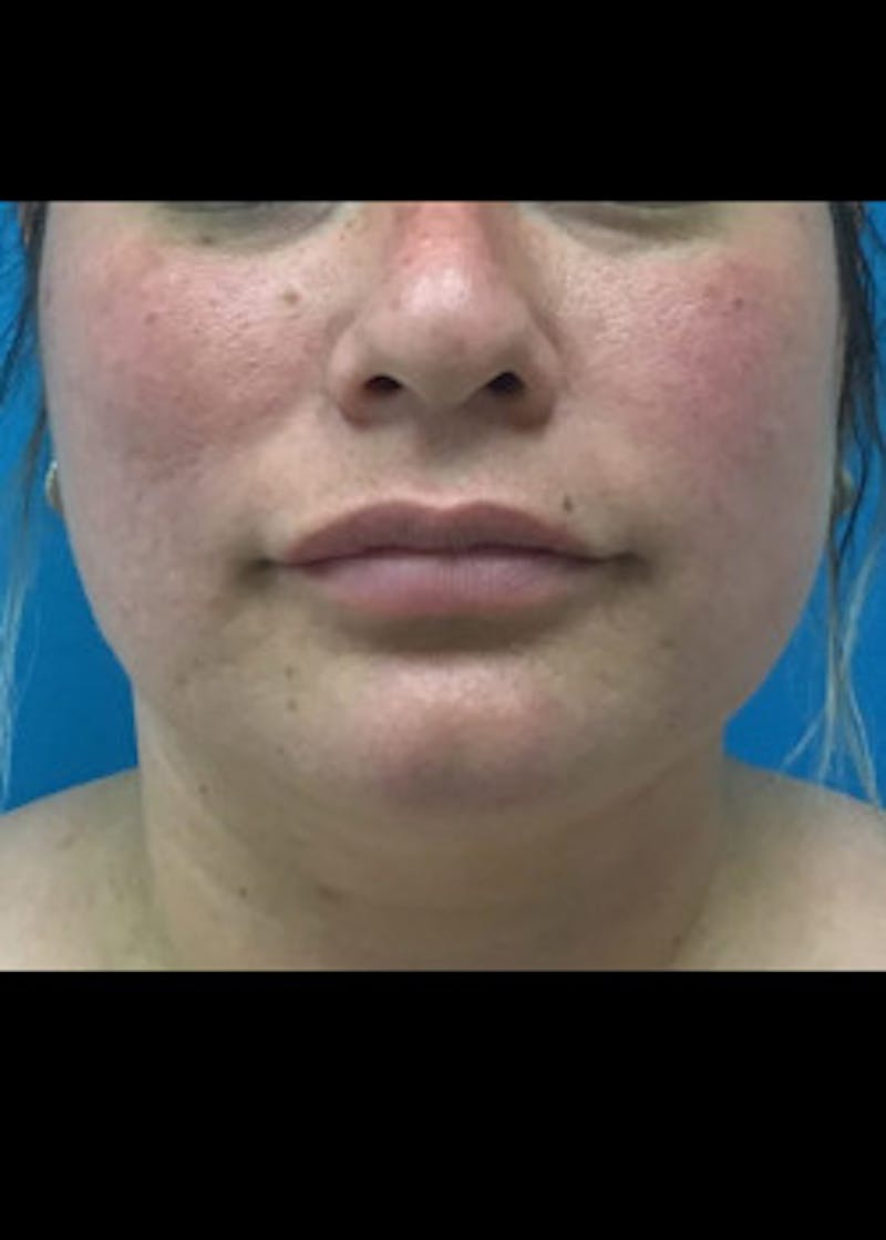 Jaw Contouring Before & After Gallery - Patient 46618842 - Image 3
