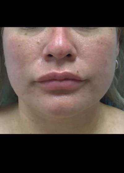 Jaw Contouring Before & After Gallery - Patient 46618842 - Image 2